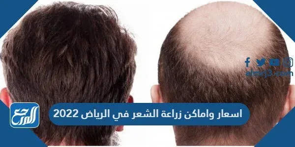 اسعار واماكن زراعة الشعر في الرياض 2022