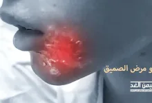 ماهو مرض الصميق وماهي أسباب مرض الصميق وأعراضه وعلاجه